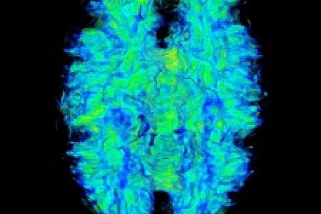 Neuroimaging